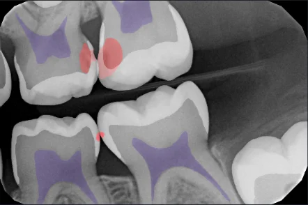 Annotated 3D scan screenshot from a mend dental scan report