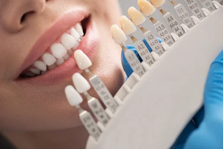 Shade-matching a ceramic bridge to natural teeth