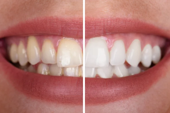 KöR teeth whitening in Irvine
