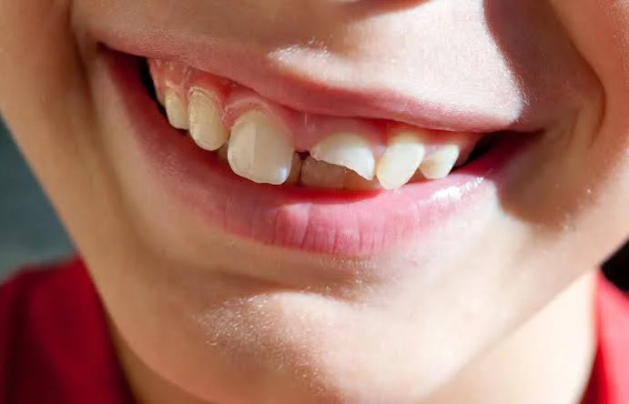 Broken tooth, emergency dental care at mend dental in Irvine
