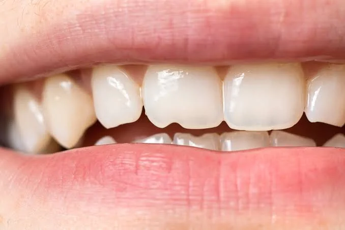 Chipped tooth, emergency dental care at mend dental in Irvine