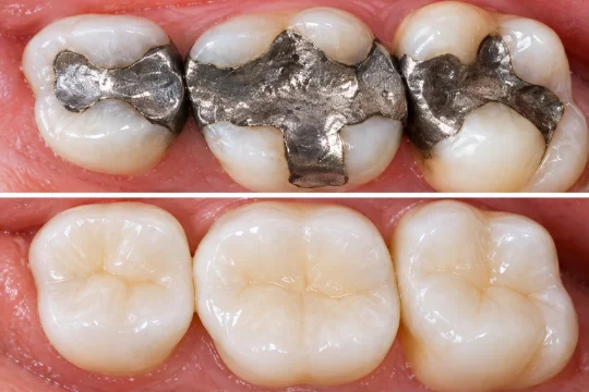 Matching composite filling shade to a patient's natural tooth color
