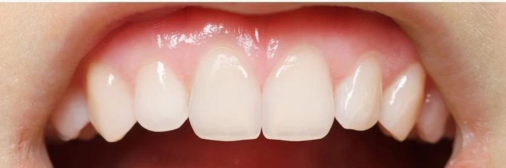 After cosmetic bonding at mend dental