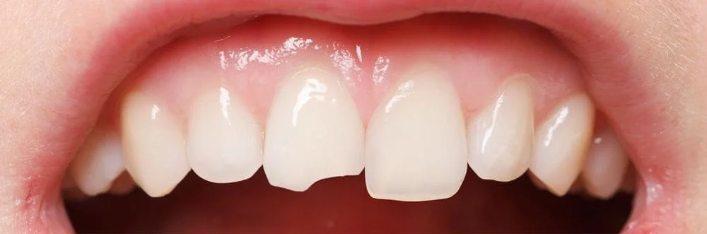 Before cosmetic bonding at mend dental