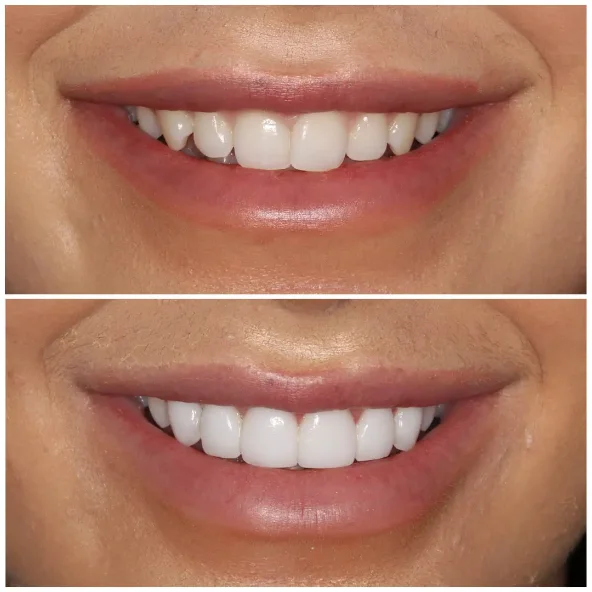 Cosmetic bonding in Irvine