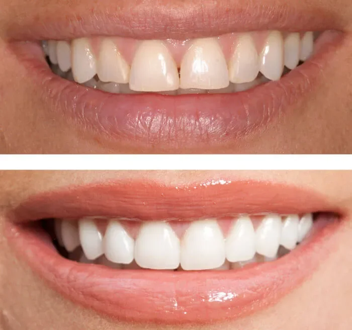 Cosmetic Bonding at mend dental in Irvine, CA