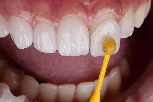 Cosmetic dentistry in Irvine
