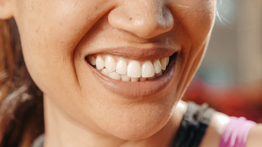 Natural-looking smile after cosmetic dentistry at mend dental in Irvine, CA