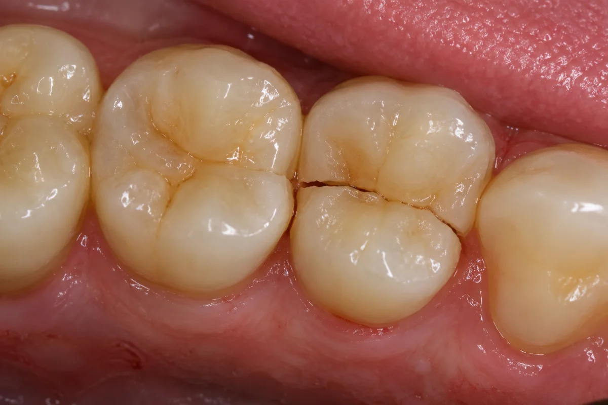 Close-up of a cracked molar on a 3D scan screen