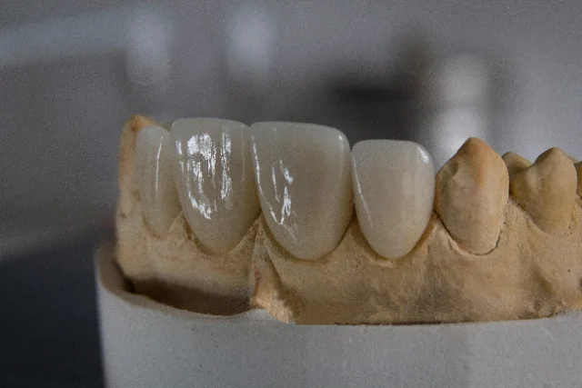 Lost Dental Crown