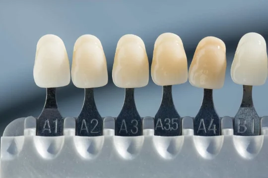 Shade-matching a ceramic crown to natural teeth
