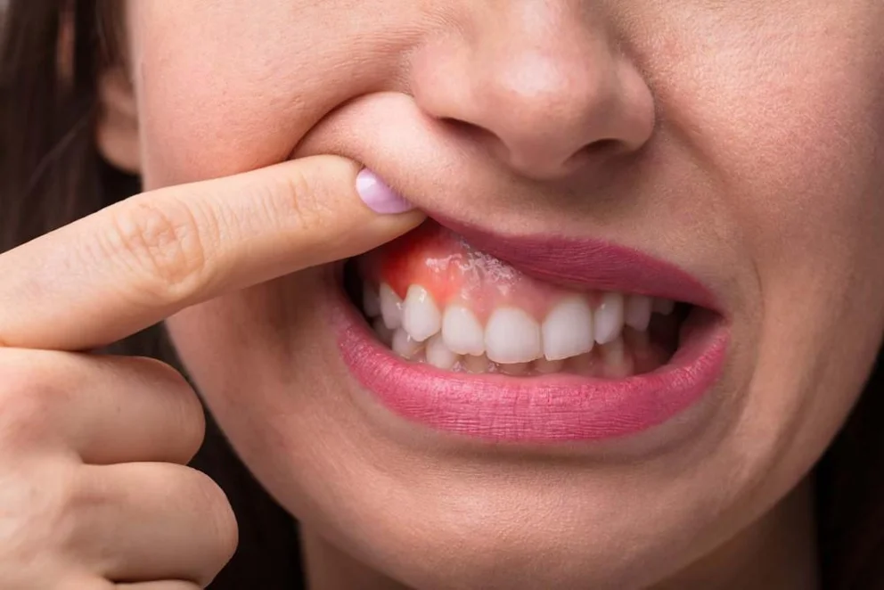 Dental abscess emergency care at mend dental in Irvine, CA
