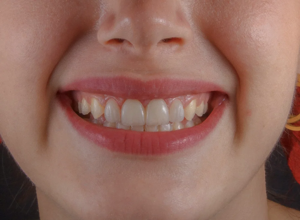Emergency visit for a dental abscess at mend dental