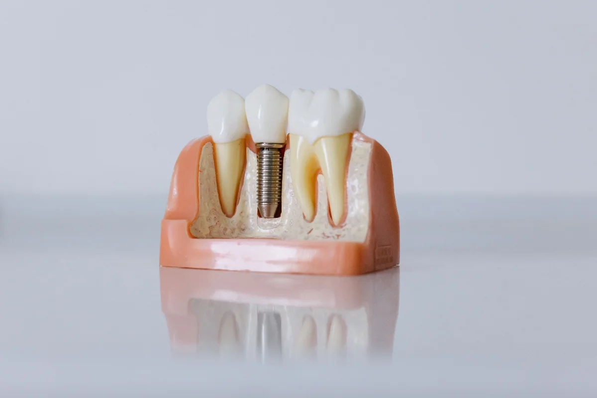 Model of a dental implant showing the titanium post and crown