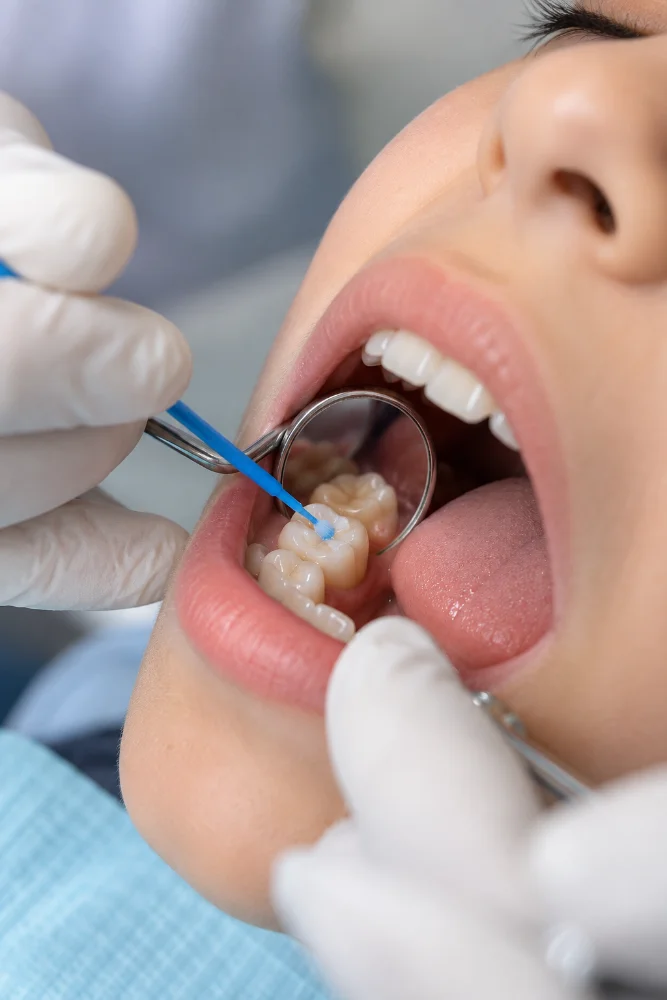 Close-up of molar grooves protected by a dental sealant