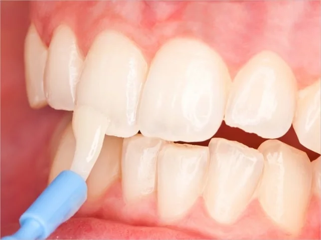 Fluoride Treatment