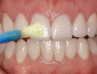 Fluoride tray and foam at mend dental