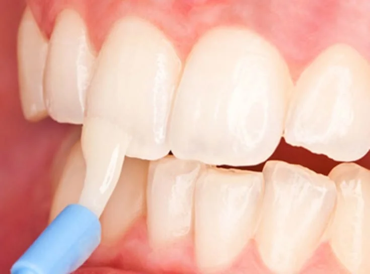 Fluoride tray being placed after a cleaning at mend dental in Irvine, CA
