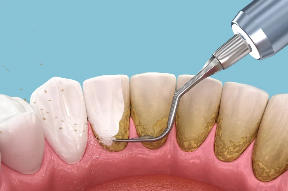 Periodontist Dr. Nischit Shah treating gum disease at mend dental in Irvine, CA