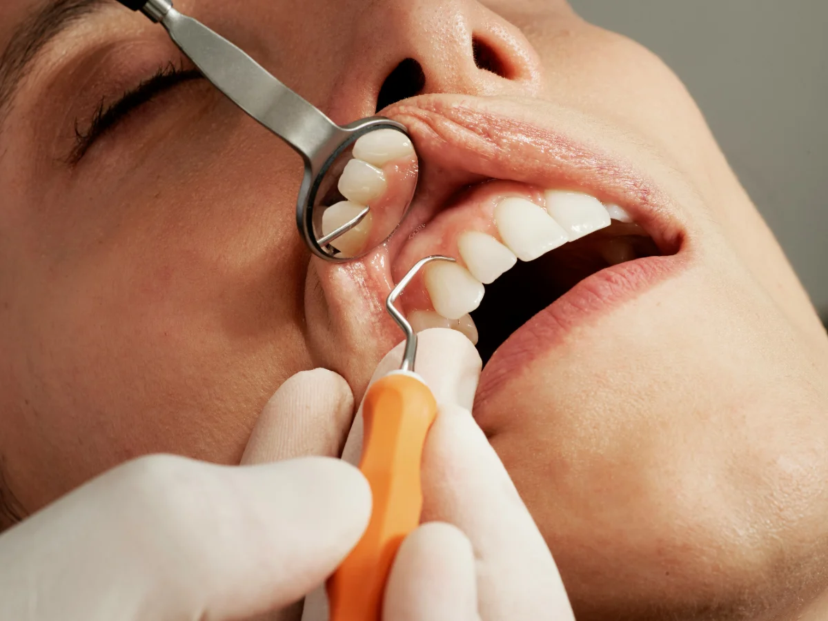 Hygienist measuring gum pockets with a periodontal probe
