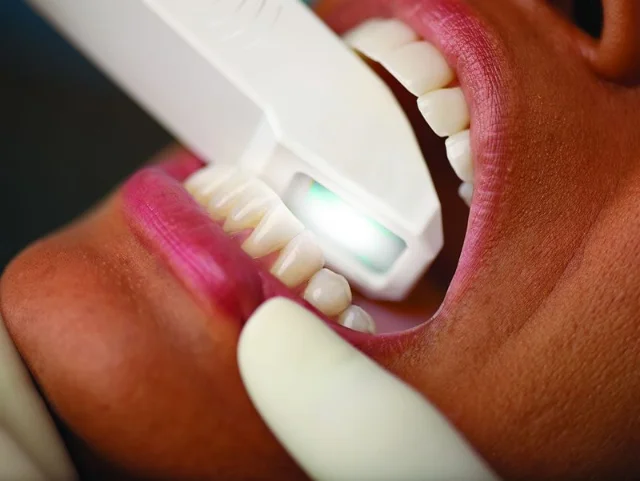 Invisalign in Irvine