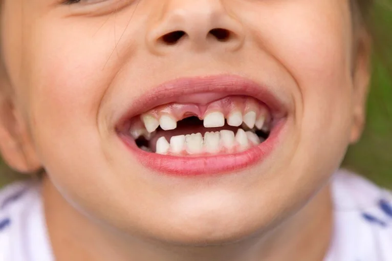 Knocked-out tooth, emergency dental care at mend dental in Irvine