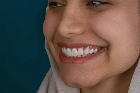 Custom-fit KöR-Seal whitening trays made for a mend dental patient