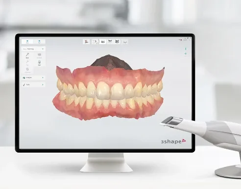 Digital 3D scan for custom whitening trays