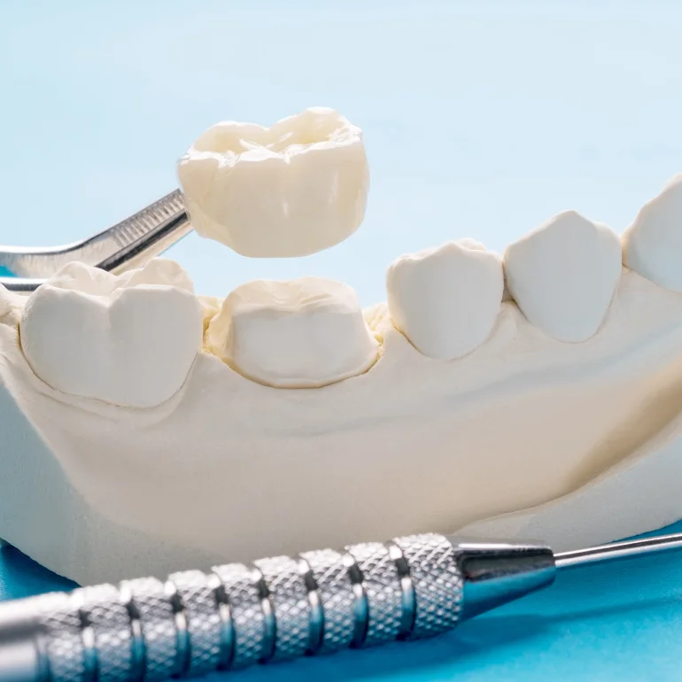 Emergency visit for a lost dental crown at mend dental