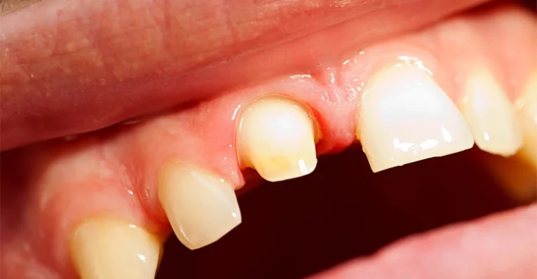 Lost dental crown, emergency dental care at mend dental in Irvine