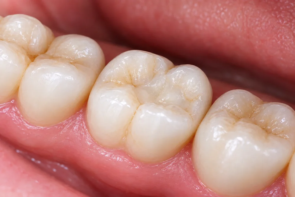 Emergency visit for a lost filling at mend dental