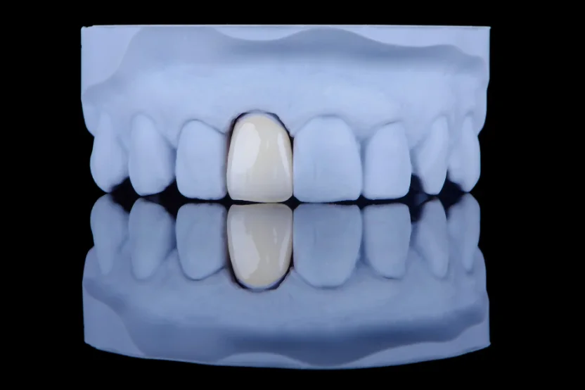 A new porcelain crown ready to be fitted at mend dental in Irvine, CA