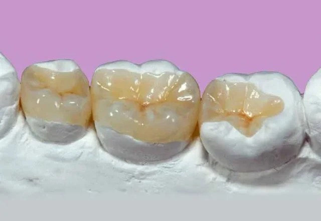Dental Onlays