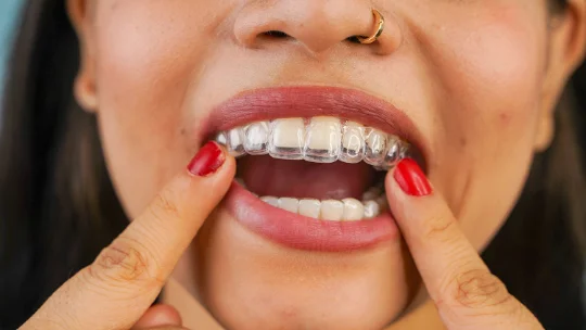Patient placing an Invisalign aligner