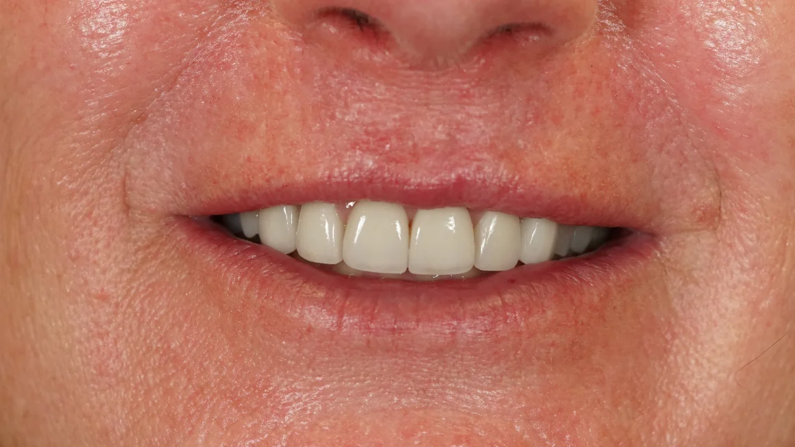 After dental veneers at mend dental