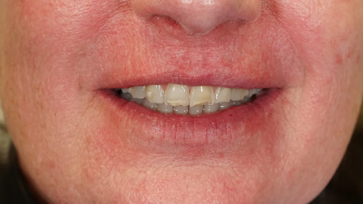 Before dental veneers at mend dental