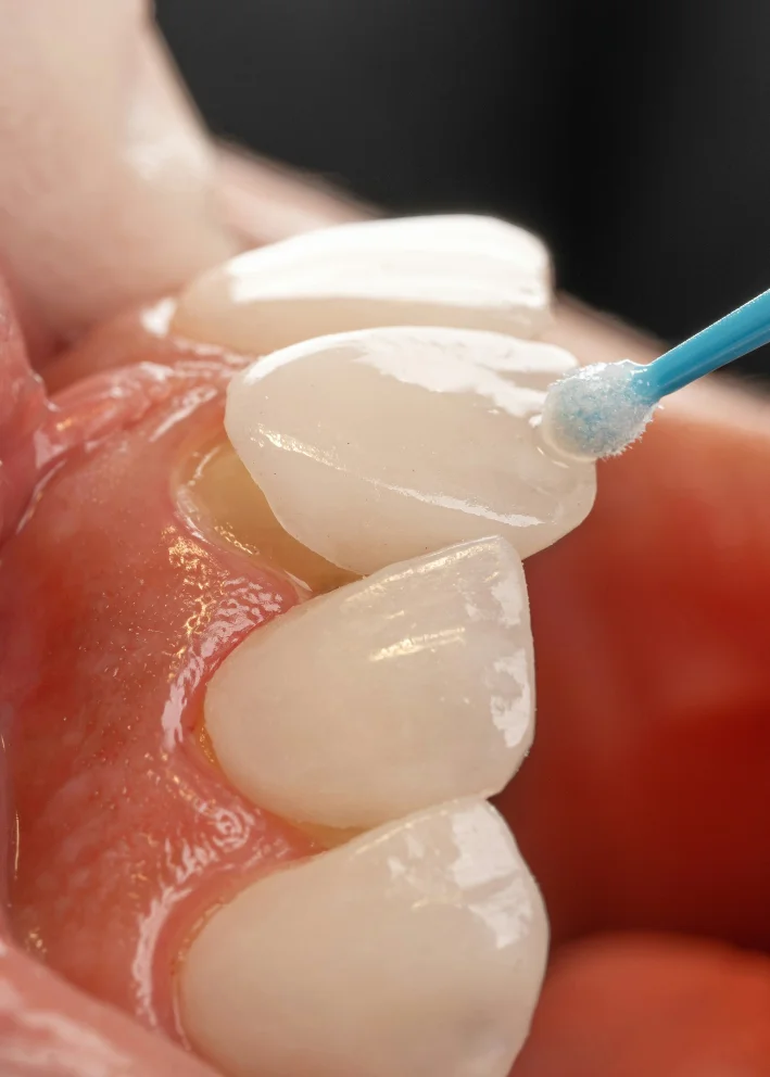 Dental Veneers at mend dental in Irvine, CA