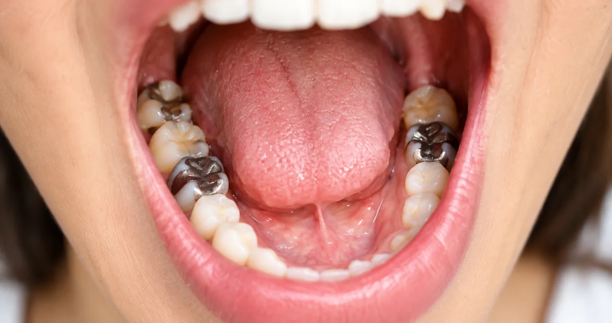 Close-up of an old silver filling next to a tooth-colored one
