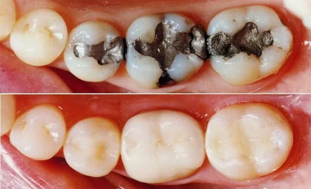Dental Fillings