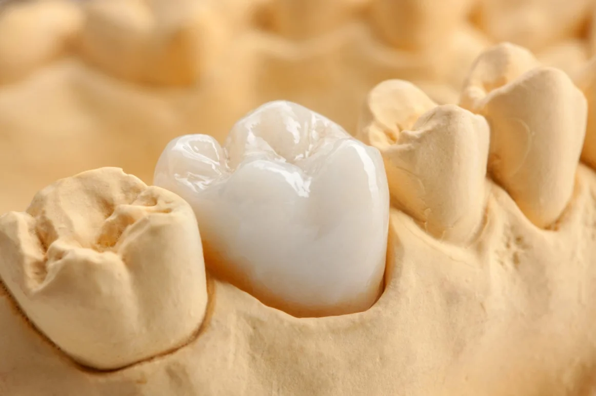 Crowns & onlays at mend dental