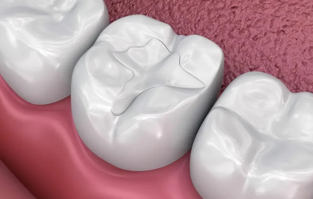 A cavity at mend dental in Irvine, CA
