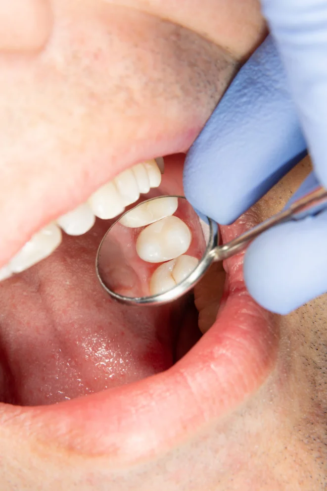 Natural-looking tooth-colored dental filling at mend dental in Irvine, CA