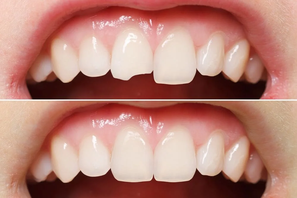 Shade guide held against a front tooth with a porcelain veneer