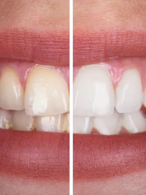 Teeth Whitening