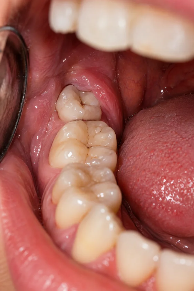 Wisdom Teeth Removal at mend dental in Irvine, CA