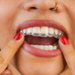 Invisalign on woman