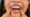 Invisalign on woman