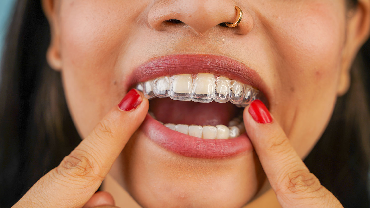 Invisalign on woman